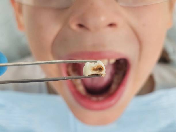 Best Emergency Dental Care for Broken or Chipped Teeth in Prospect Rk, PA